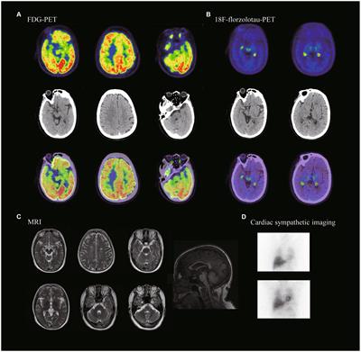 A novel MAPT variant (E342K) as a cause of familial progressive supranuclear palsy